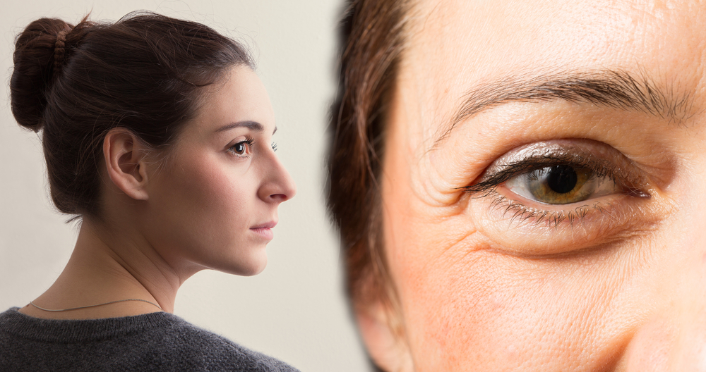 Botox for Crow's Feet