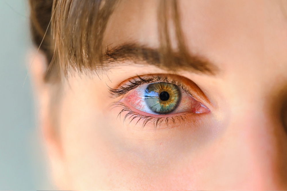 When to Book Same-Day Primary Care in Fairfax, Virginia for Pink Eye Treatment